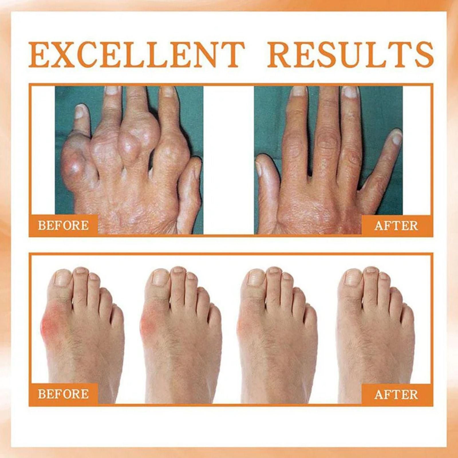 Bee Venom Beesae Arthritis Spreay 100ML